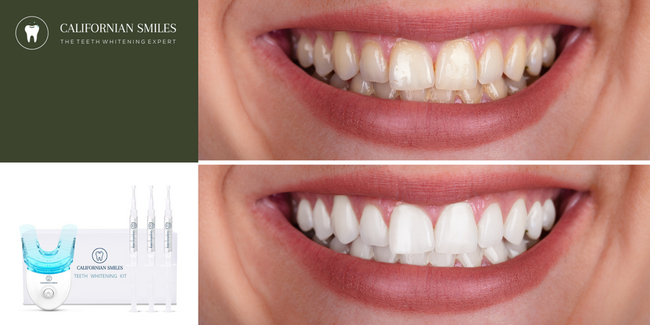 The tooth whitening kit: is it safe for all types of teeth?