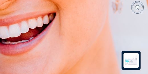 What are the advantages of teeth whitening with a kit?