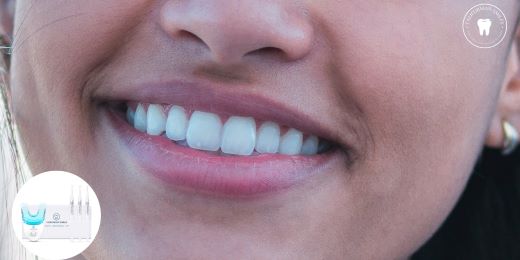 How to choose the best teeth whitening kit?