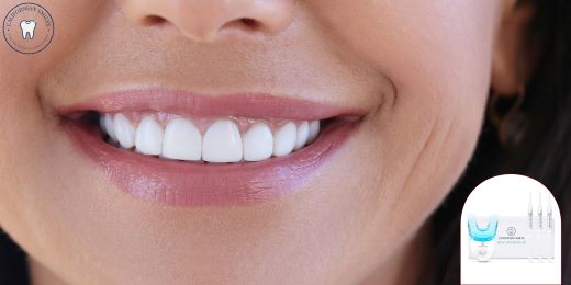 Can teeth whitening kits help remove fluorosis stains?