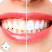 Load image into Gallery viewer, Teeth Whitening Kit

