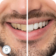 Load image into Gallery viewer, Teeth Whitening Kit
